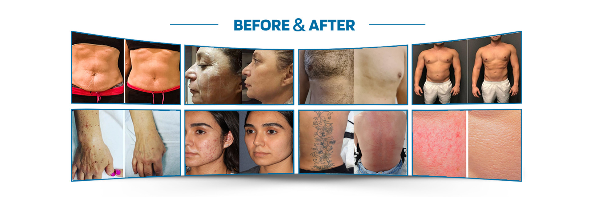 qualità Macchina di depilazione del laser fabbrica